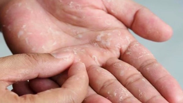 শরীরের মরা চামড়া উঠে গেলে অজু ভাঙবে?