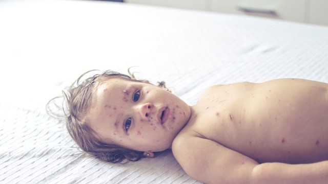 হামে আক্রান্ত শিশুর যত্ন ও সঠিক খাদ্যতালিকা