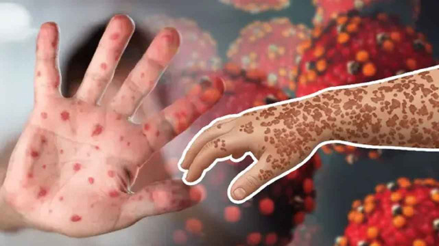 হাম ও উপসর্গে আরও ১১ জনের মৃত্যু, আক্রান্ত বাড়ছে