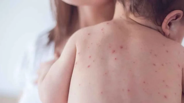 হামের উপসর্গে আরও ৭ শিশুর মৃত্যু, ২৪ ঘণ্টায় হাসপাতালে ভর্তি ১,২৮২