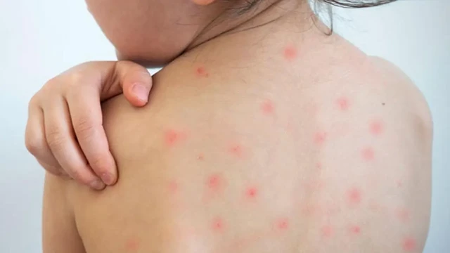 হামের লক্ষণ নিয়ে তিন বিভাগে আরও ৪ শিশুর মৃত্যু