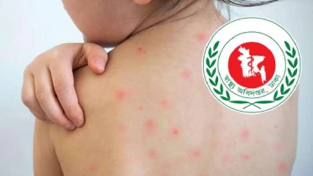 হামের উপসর্গে ২৪ ঘণ্টায় আরও ৫ শিশুর মৃত্যু, আক্রান্ত বাড়ছে