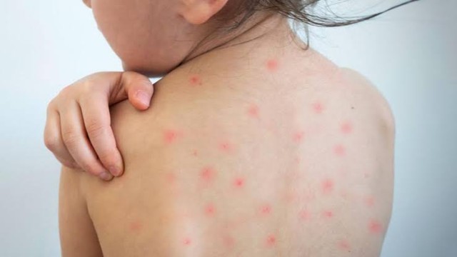 হামের প্রাদুর্ভাব: বৈশ্বিক সংকট নাকি অভ্যন্তরীণ অব্যবস্থাপনা?