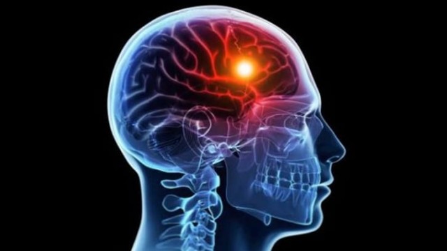 স্ট্রোকের ঝুঁকি কমাতে বিজ্ঞানীদের নতুন উদ্ভাবন